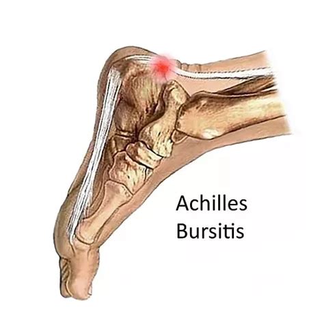Achilles Bursitis Achilles Tendinosis Achilles Tendonitis Treatment