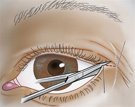 Optic Nerve Compression Performing A Surgical Canthotomy W Flickr