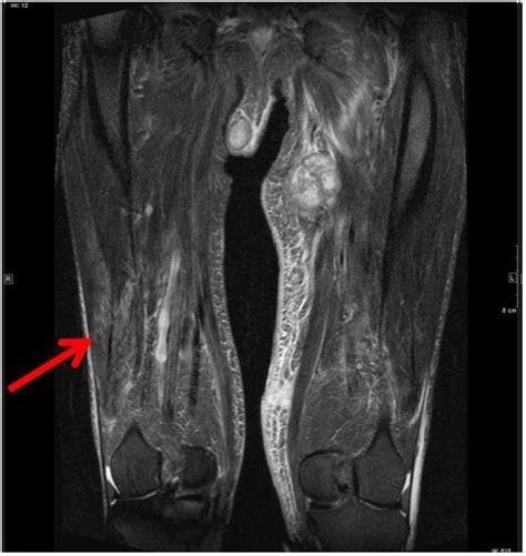Mri Scan Of The Lower Extremities Showing T2 Hyperintense Changes Of