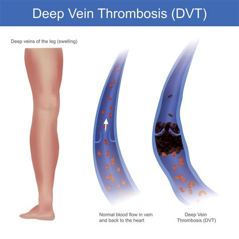 Deep Vein Thrombosis Dvt Overview Causes Symptoms Treatment