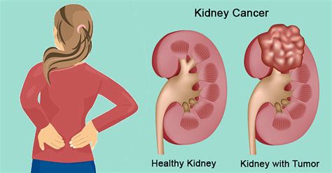 A person with kidney or renal pelvis cancer may or may not have one or more of the symptoms listed here. 11 Kidney Cancer Symptoms (and How to Manage it Naturally)