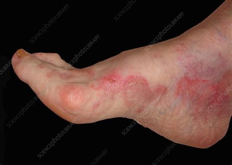 Ringworm Fungal Infection Stock Image C0473504 Science Photo Library
