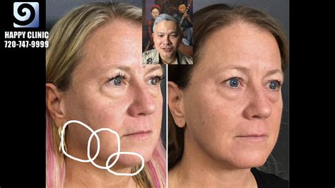 Agnes Radiofrequency For Jawline Sharpening And Undereye Bags At Happy Clinic YouTube