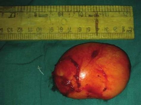 Epidermoid And Pilar Cysts Sebaceous Cysts Causes And Removal Patient