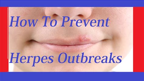 How To Prevent Herpes Outbreak How To Treat Genital Herpes YouTube