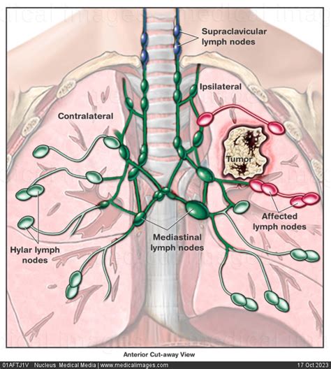 Stock Image Illustration Of Lung Cancer And The Thoracic Lymph Nodes