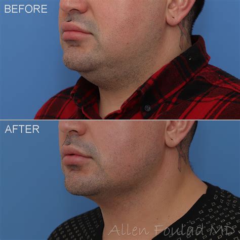 Neck Chin And Face Liposuction Beverly Hills Los Angeles