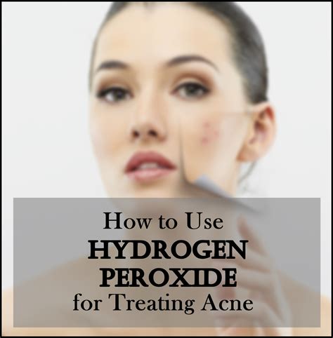 how to use hydrogen peroxide for treating acne
