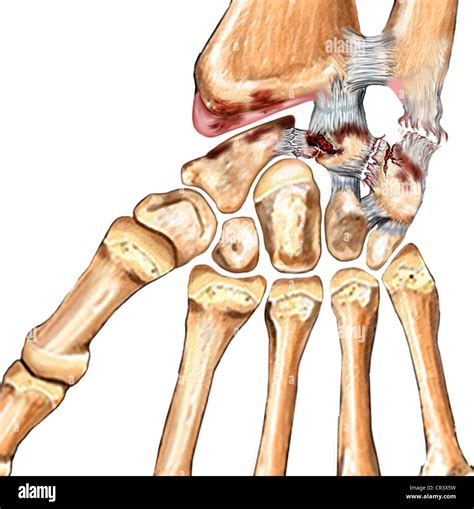 This Medical Illustration Features The Torn Ulnar Collateral Ligament Stock Photo Alamy