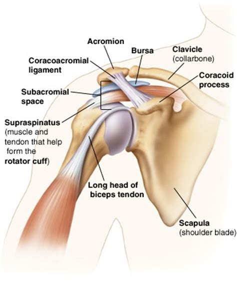 Impingement is most commonly caused by straining (due to performing many serves and high forehands), an imbalance of the muscles around the shoulder (the front shoulder muscles are much stronger than the back ones). Shoulder Impingement | Beacon Orthopaedics & Sports Medicine
