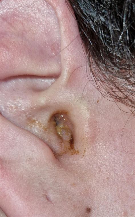 Blood Blister Inside Ear Rearwax