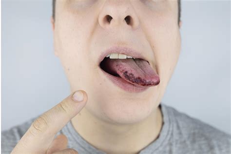 Black Spots On The Tongue Symptoms Causes And Treatment