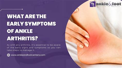 What Are The Early Symptoms Of Ankle Arthritis By Ankle And Foot