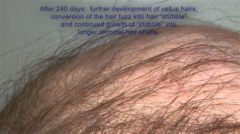 Or you can understand in the way which, every strand of your hair will resume itself once in this time phase. Can Scalp Hair Grow Back? - YouTube