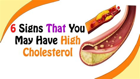 High Cholesterol Symptoms 6 Signs That You May Have High Cholesterol