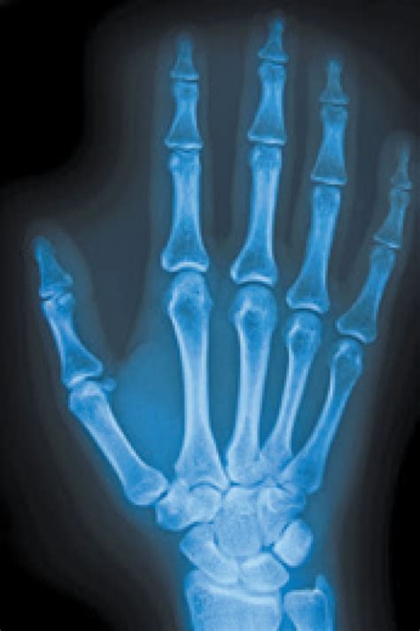 A Severe Type Of Osteoarthritis Arthritis Advisor
