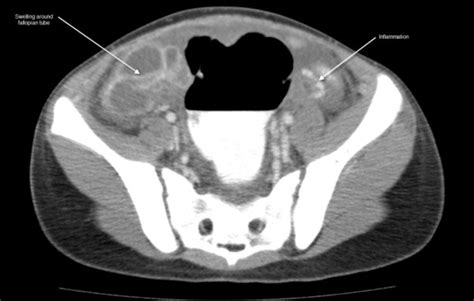 Ct Scan Of The Abdomen And Pelvis With Intravenous And Oral Contrast