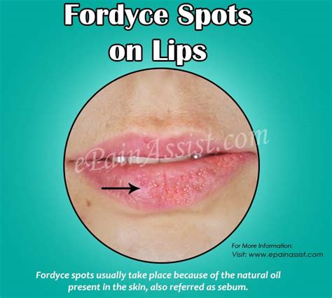 Fordyce Spots On Lips Treatment All You Need Infos