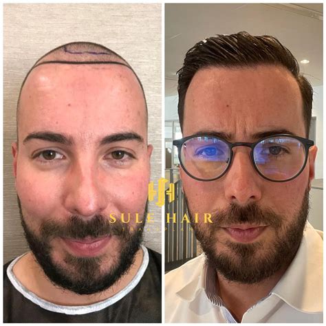 Hair Transplant Turkey Before And After Photos Sule Clinic
