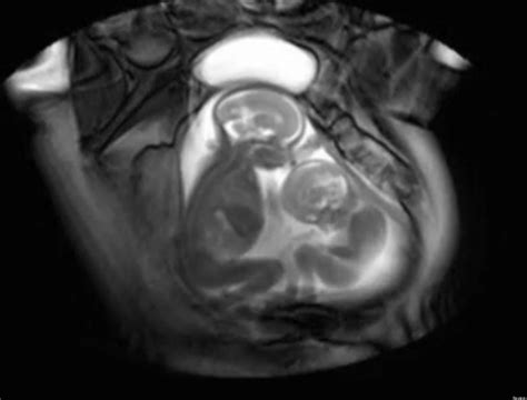 Twins Fighting In Womb Video New Mri Technique Reveals Early Double