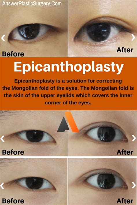 What Is Epicanthoplasty Details Of The Procedure Operation Process