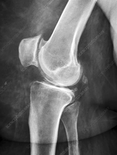 Arthritis Of The Knee X Ray Stock Image F0117609 Science Photo