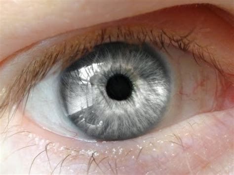 Темное пятно на белке глаза фото — Galeratutru
