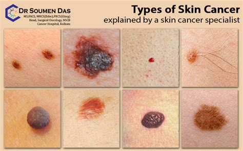 Cancer Bumps On Skin