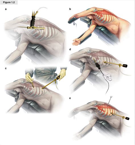 Video Assisted Thoracoscopic Surgery Thoracic Key