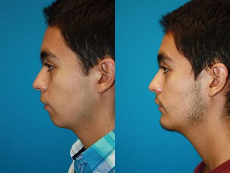Chin Augmentation Before And Afters Crantford Costa Plastic Surgery