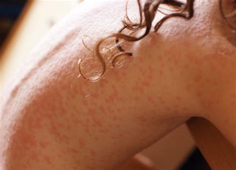 Dermatite O Que Sintomas Tipos Da Doen A E Como Tratar Hot Sex Picture