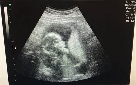 Can Ultrasounds Be Wrong BabyCenter
