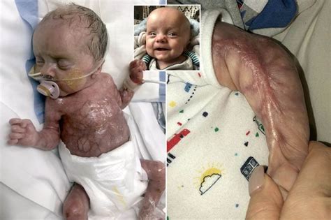 Miracle Baby Born With No Skin And 30 Weeks Premature