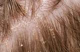 Photos of How Can I Treat Psoriasis On My Scalp