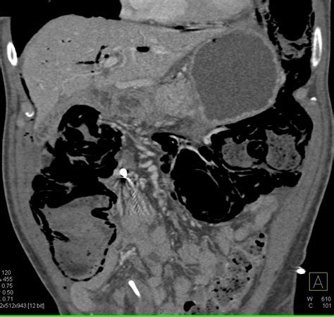 Ischemic Bowel With Portal Venous Air And Pneumatosis Of The Colon