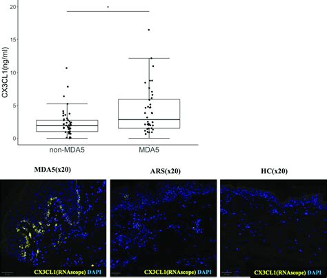 Pos0785 The Role Of Cx3cl1cx3cr1 Axis In The Pathogenesis Of Anti