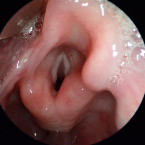 A Normal Larynx And Vocal Cords Photographed During Surgery J Scott