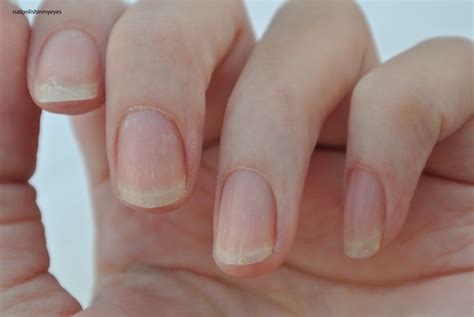 How Eczema Affected My Nails Nail Polish In My Eyes