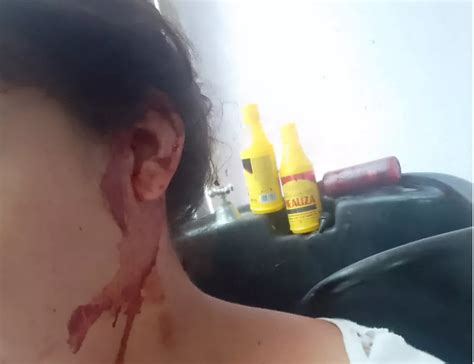 Mulher leva mordida na orelha após reclamar de som alto Alagoas 24