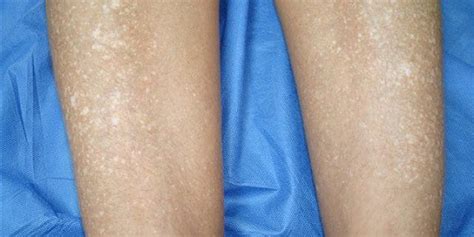 White Spots On Body And How To Treat Them