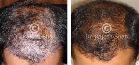 Scalp Psoriasis Before After Treatment Image Dorothee Padraig South