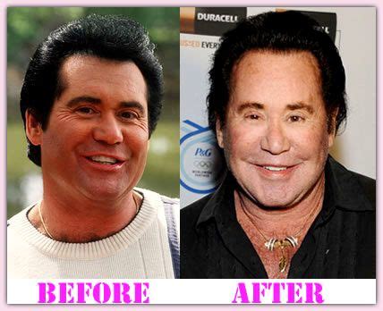 Wayne Newton Plastic Surgery Before And After # ...