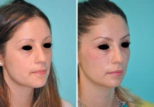 Tear Trough Under Eye Injections Before And After Photos Page Of