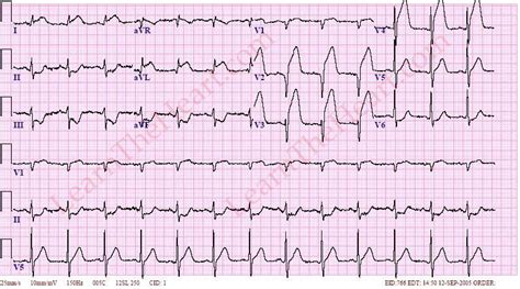 Anterior Wall St Segment Elevation Myocardial Infarction Mi Ecg