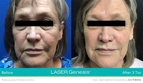 Laser Genesis Skin Rejuvenation — The Skin Centre
