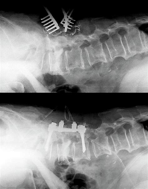 Spinal Compression Fractures In Surgery Photograph By Zephyr