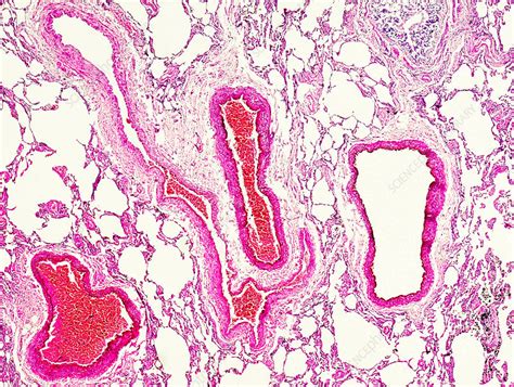 Acute Alveoli Emphysema Light Micrograph Stock Image C0524958