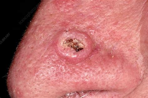 Hyperkeratosis Stock Image C0345352 Science Photo Library