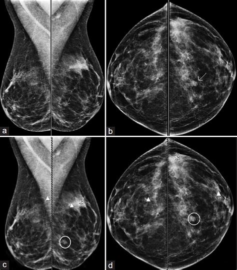 A D 53 Year Old Woman With Invasive Ductal Carcinoma A B Left