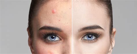 Breaking It Down With Pimple Vs Zit Vs Acne Know The Difference And